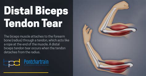 biceps tendon tear test|imaging for bicep tendon rupture.